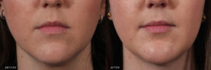 How Is a Chin Augmentation Performed