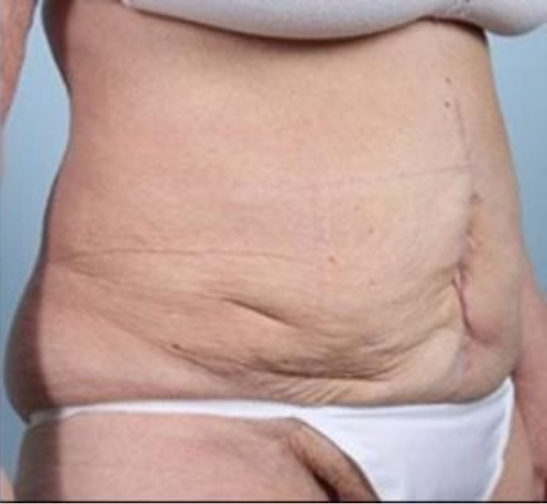 Tummy Tuck Before and After Pictures Case 49, Albany & Latham, New York