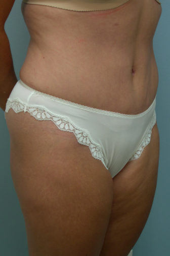 Angled profile of a female showing tightened skin after a tummy tuck surgery