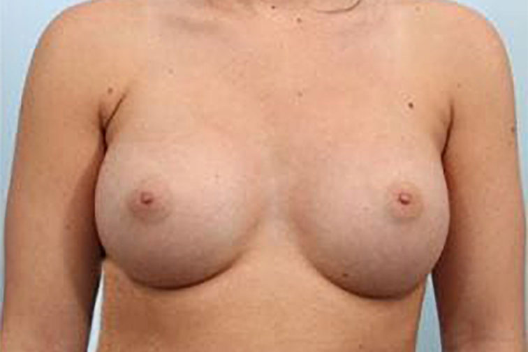 Closeup of a female body showing larger breasts after breast augmentation plastic surgery