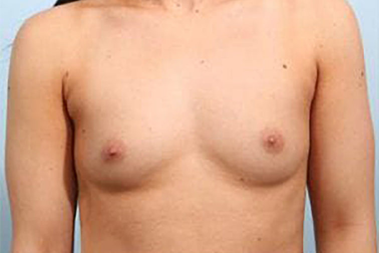 Closeup of a female's body showing small breasts before breast augmentation surgery