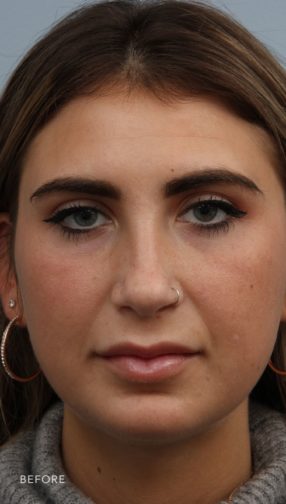 This is the front view of a brunette woman before her buccal fat pad removal procedure. She has excess fat on her cheeks and chin.