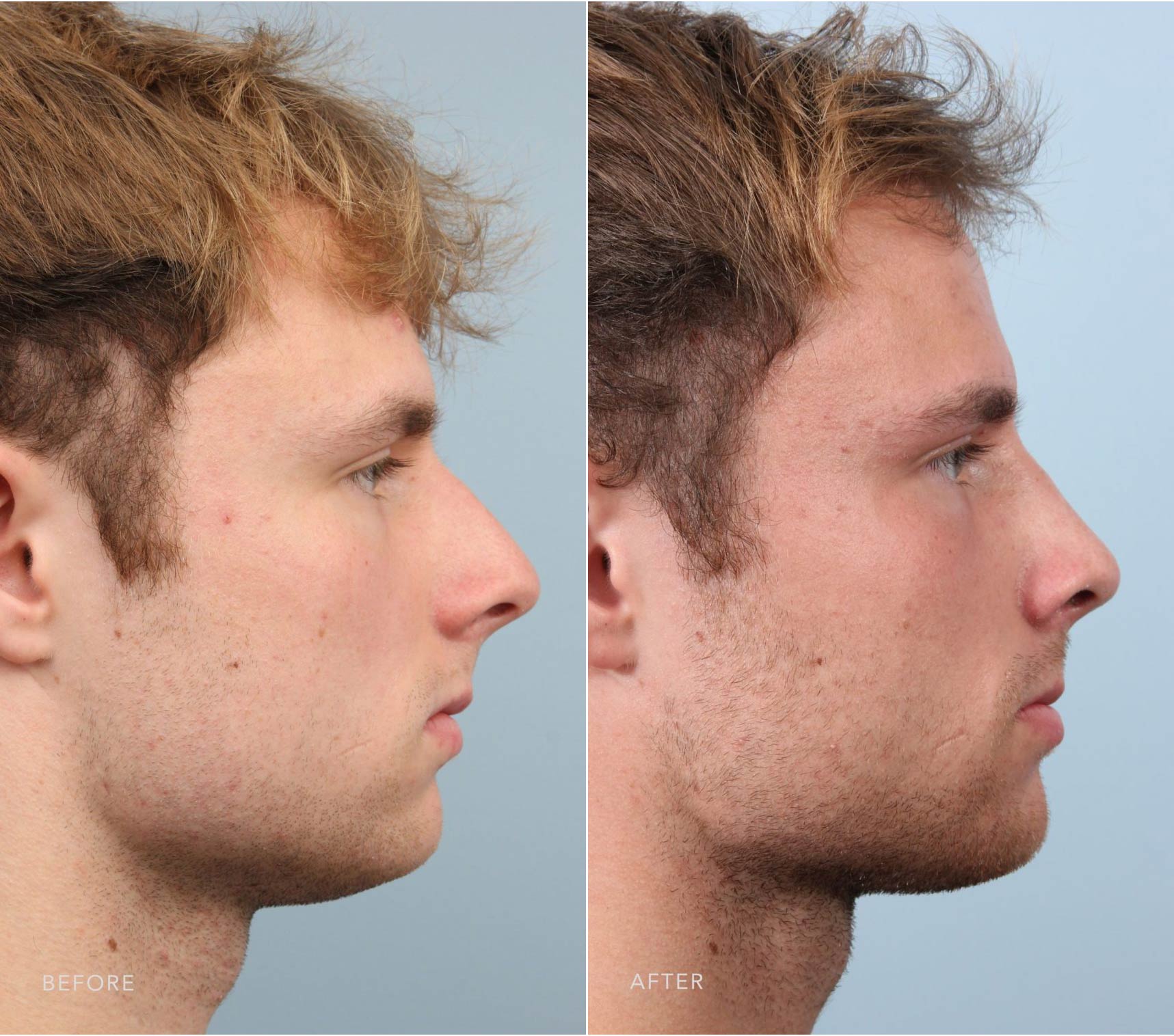 what-is-nonsurgical-rhinoplasty-risks-and-results-of-nose-fillers-allure