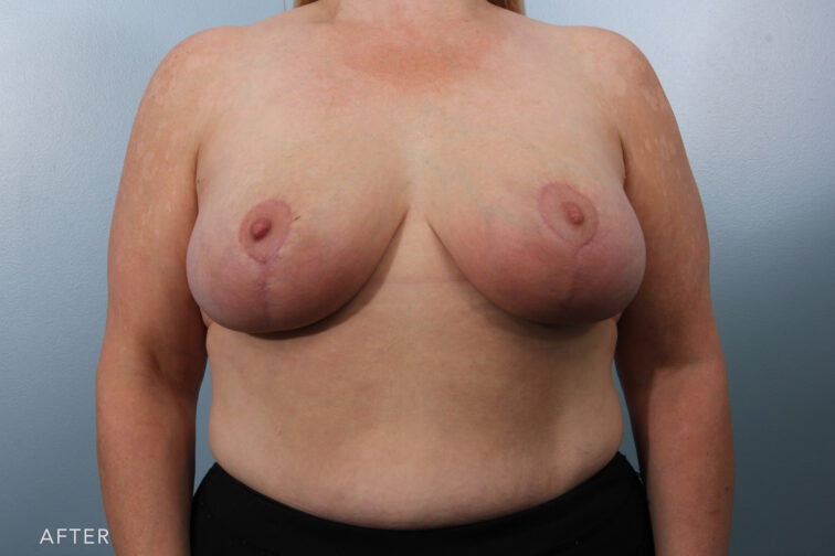 Photo of a woman's breasts taken from the front angle after breast lift surgery. They are smaller and lifted back to normal position. | Albany, Latham, Saratoga NY, Plastic Surgery