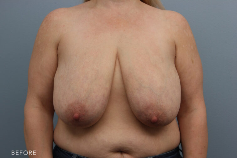 Photo of a woman's breasts taken from the front view. Before breast lift surgery her breasts droop to near her belly button. | Albany, Latham, Saratoga NY, Plastic Surgery