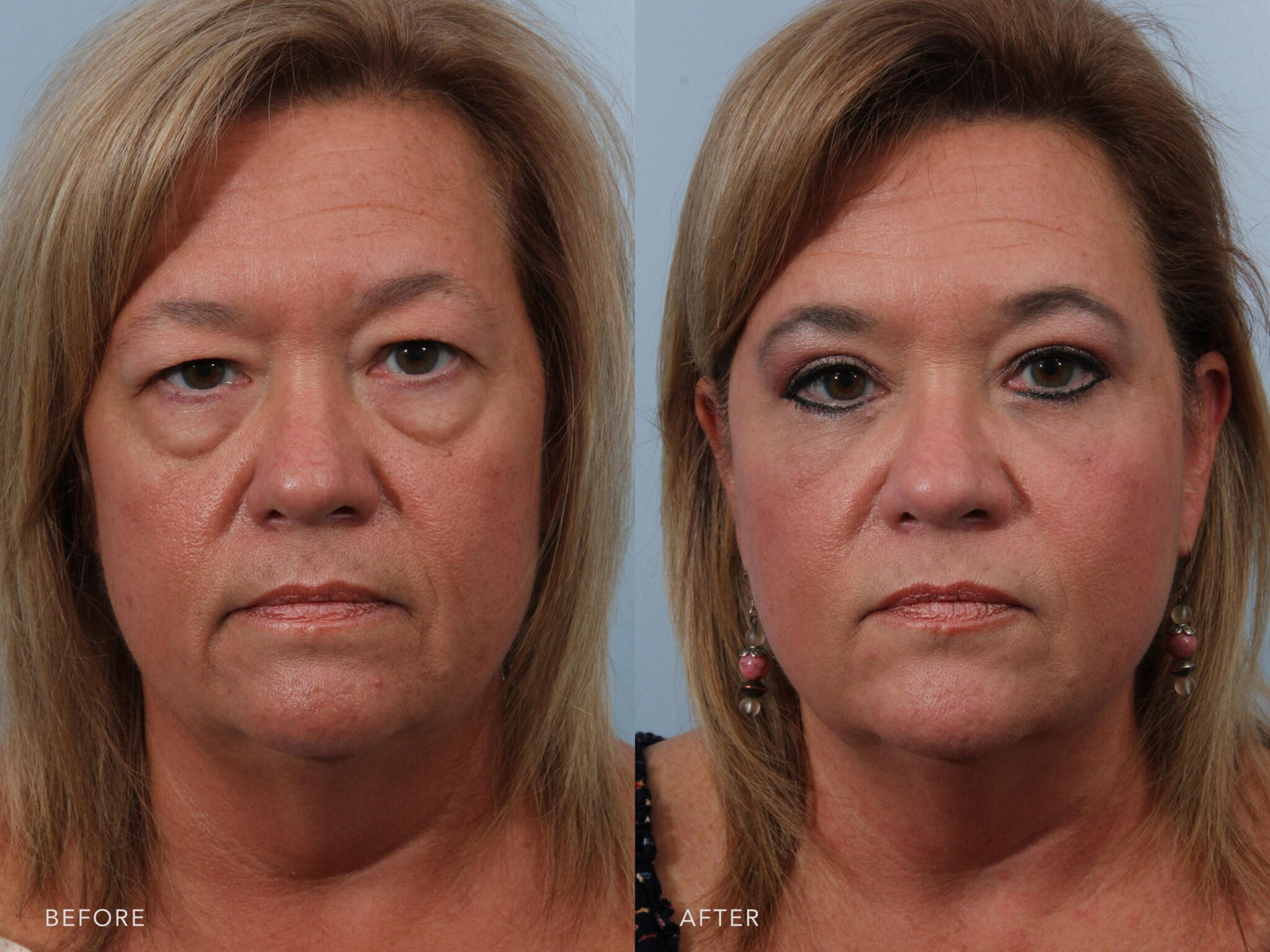 How Much Does Eyelid Surgery Cost Williams Center Williams Center 2280