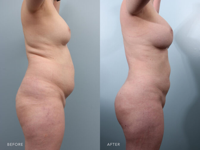 Side by side before and after of a woman's body from the side angle who had a mommy makeover. Before surgery her buttocks were flat and had no shape, her stomach and back had excess fat and skin, and her breasts were smaller than she would have liked. After surgery her buttocks are more full and rounded, her breasts have bigger implants, and excess fat around the stomach and back were removed with liposuction. | Albany, Latham, Saratoga NY, Plastic Surgery