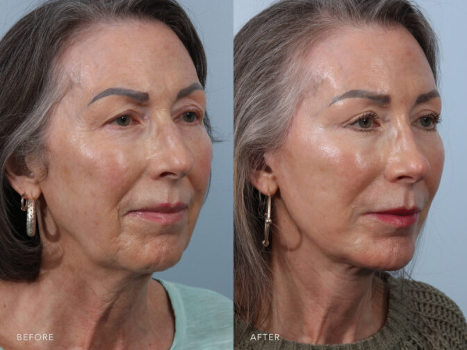 This is a side by side view photos of a woman's face before and after Deep Plane Lower Face and Neck Lift procedure. Before photoo shows a double chin due to excess fat cells around the neck while after phot shows more definition along chin and neck area. | Albany, Latham, Saratoga NY, Plastic Surgery