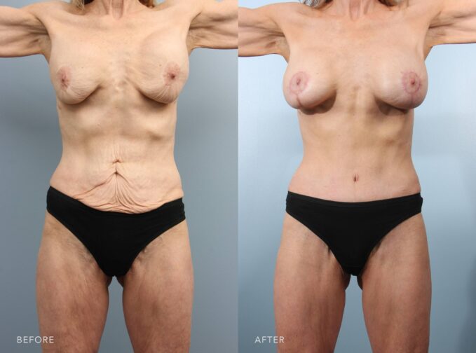 A photo of a woman's body before and after the Breast Revision procedure. Before photo shows wrinkled breasts due to aging, causing the natural breast tissue to sag, leading to a mismatched appearance of her breasts. The after photo shows an enhanced breast shape with rounder and smoother breasts, resulting in a more balanced and harmonious appearance. | Albany, Latham, Saratoga NY, Plastic Surgery