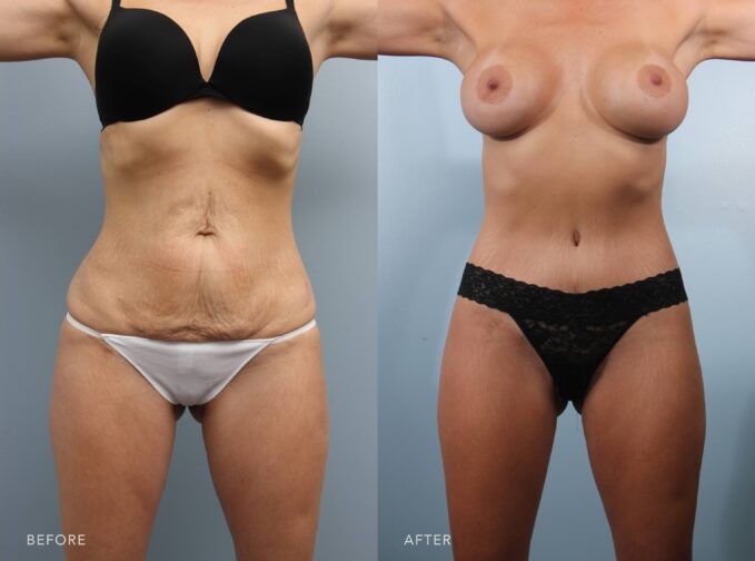 A photo of a woman's body before and after the Body Lift procedure. Before photo shows stretched and thin skin, lacking the firmness to conform to the underlying muscle structure. The after photo shows eliminated loose skin folds and wrinkles. Her skin appears tighter and smoother across the abdomen, leaving a more polished look. | Albany, Latham, Saratoga NY, Plastic Surgery