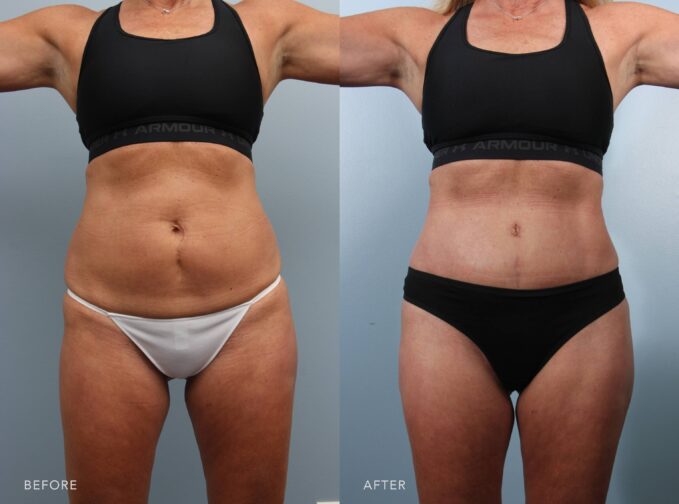 A photo of a woman's body before and after the Tummy Tuck procedure. The before picture shows excess skin and fat around her abdomen, making the waist appear less contoured. The after photo shows balanced proportions with her midsection appearing more harmonious to the rest of her body, enhancing curves and symmetry. | Albany, Latham, Saratoga NY, Plastic Surgery