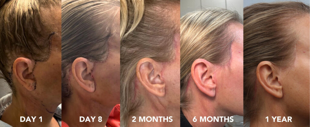 Photo showing the incision lines of a deep plane facelift surgery.