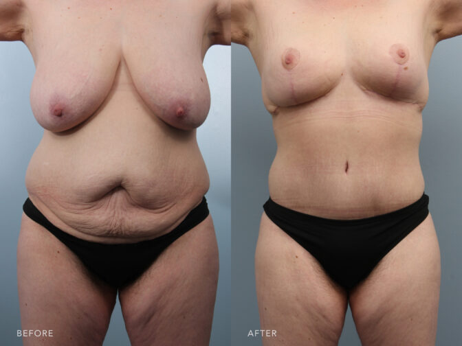 A photos of a woman's body before and after Abdominoplasty with Liposuction procedure. Before photo shows a sagging skin and localized fat deposits in her abdomen while after photo shows a flatter and smoother stomach area.| Albany, Latham, Saratoga NY, Plastic Surgery