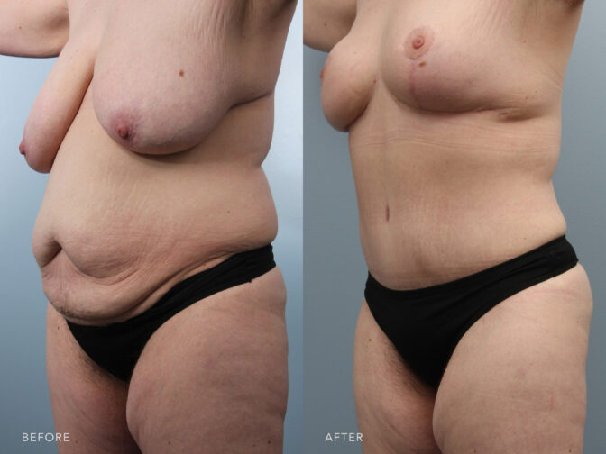 A photos of a woman's body before and after Abdominoplasty with Liposuction procedure. Before photo shows a sagging skin and localized fat deposits in her abdomen while after photo shows a flatter and smoother stomach area.| Albany, Latham, Saratoga NY, Plastic Surgery