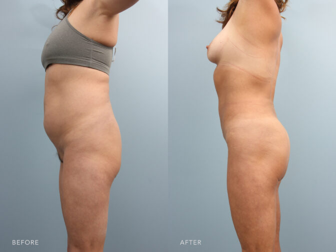 A side-by-side view of a woman's body before and after Lipodystrophy of the Abdomen, Back, and Flanks procedure. Before photo shows a limited projection from the back of her hips, resulting in a flatter profile when viewed from the side. While the after photo shows curved buttocks projecting outwards from the back of her hips, creating a more prominent profile when viewed from the side. | Albany, Latham, Saratoga NY, Plastic Surgery