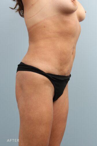 A photo of a woman's body shows less bulging or protrusion, creating a smoother and more streamlined appearance. | Albany, Latham, Saratoga NY, Plastic Surgery