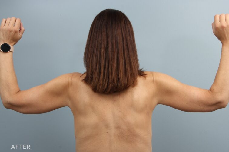 A photo of a woman's upper body shows the natural shape of her upper arms resulting in a well-toned between the shoulder and the elbow. | Albany, Latham, Saratoga NY, Plastic Surgery