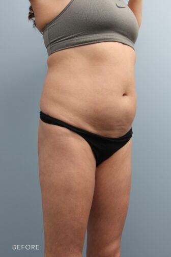 A photo of a woman's body shows a significant amount of fat tissue in her abdomen, leading to a visibly enlarged and rounded appearance in her midsection. | Albany, Latham, Saratoga NY, Plastic Surgery