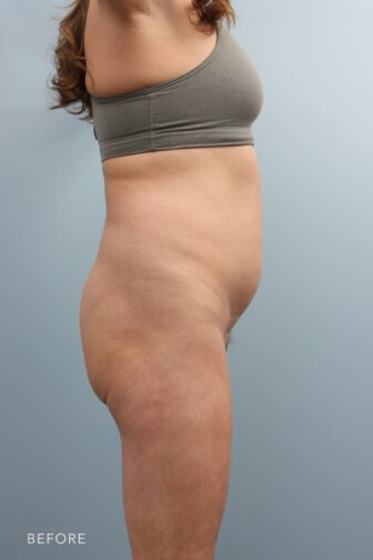 A photo of a woman's body shows bulgy flanks, creating a rounded contour, particularly when standing from a side view due to the accumulation of fat in this region. | Albany, Latham, Saratoga NY, Plastic Surgery