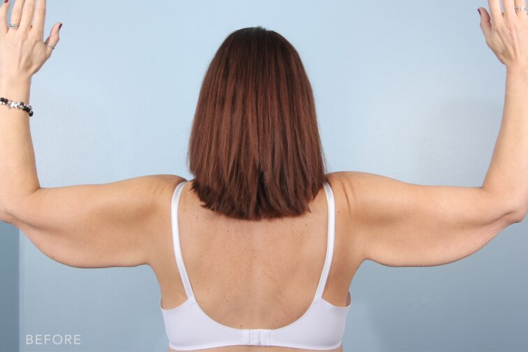 A photo of a woman's upper body shows a wide and thick appearance in her upper arms, which made it noticeable when her arms are raised or extended. | Albany, Latham, Saratoga NY, Plastic Surgery