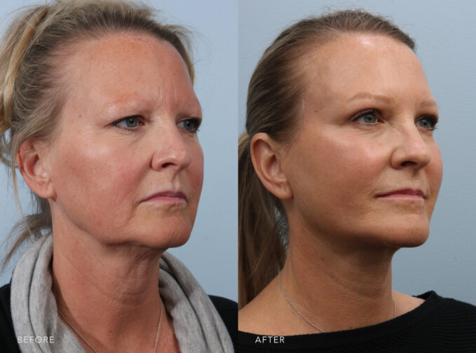 A side-by-side view of a woman before and after the Deep Plane Lower Face and Neck Lift procedure. Before photo shows a natural aging process leading to a reduction in collagen production and skin elasticity, contributing to her sagging skin. While the after photo shows a restored lost volume due to aging, resulting in a lifted cheek and an improved appearance of sagging. | Albany, Latham, Saratoga NY, Plastic Surgery