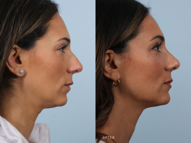 A side-by-side view of a woman's face before and after Endonasal Cosmetic Rhinoplasty procedure. Before photo shows a pronounced and extended slope along her nasal bridge and tip, creating a more vertical or oblique angle than a nose with a more balanced or harmonious length. While the after photo shows her nose that aligns well with her forehead and flows smoothly to her nasal tip, complementing her nasal bridge without being overly projected or under-projected. | Albany, Latham, Saratoga NY, Plastic Surgery