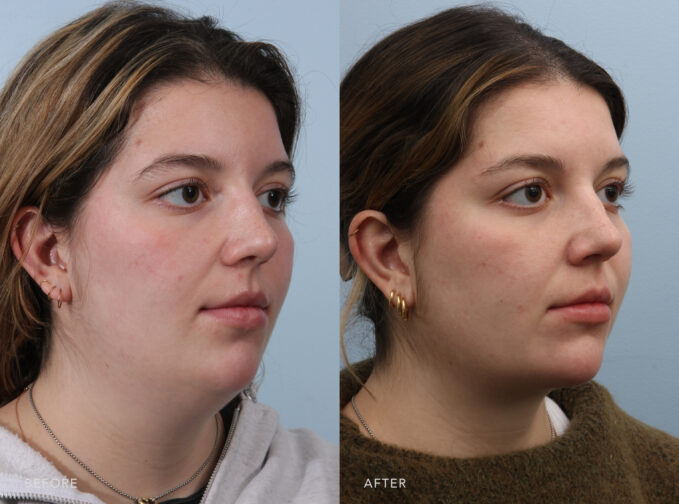 A side-by-side view of a woman before and after the Submental Liposuction and Anterior Platysmaplasty procedure. Before photo shows a less defined look on her neck with her sagging skin caused by aging, while the after photo shows removed or repositioned excess fat in her neck, creating a smoother neck profile. | Albany, Latham, Saratoga NY, Plastic Surgery