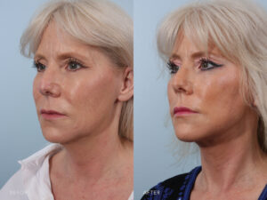 Female patient showcasing results of deep plane facelift