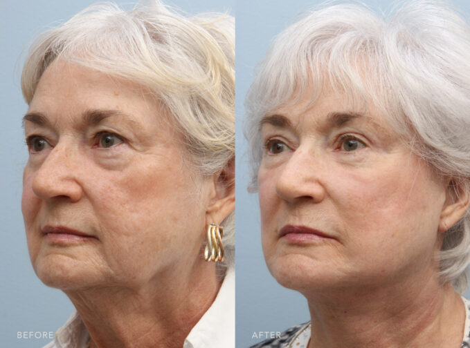 A side-by-side view of a woman's face before and after Deep Plane Lower Face and Neck Lift procedure. Before photo describes a concave or indented appearance in her cheek area, indicating a loss of volume and fullness. While the after photo shows an increase of volume in the cheek area, resulting to a rounded and more youthful appearance. | Albany, Latham, Saratoga NY, Plastic Surgery