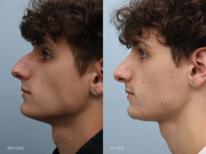 A side-by-side view of a man's face before and aftr Cosmetic Endonasal Rhinoplasty. Before photo indicates that his nose is not alligned with the centerline of his face, contributing to a bended appearance. While the after photo displays a balanced and symmetrical structure of his nose with both side mirroring each other, providing a clear endpoint to the nose without being overly rounded or pointed. | Albany, Latham, Saratoga NY, Plastic Surgery