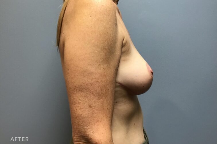 A photo of a woman's body with her breats that are positioned higher on her chest, giving the appearance of a greater lift and projection. | Albany, Latham, Saratoga NY, Plastic Surgery