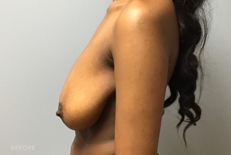 A photo of a woman's body with her breasts that draped or hang loosely from her chest wall, exhibiting a significant degree of sagging and lack of support. | Albany, Latham, Saratoga NY, Plastic Surgery  