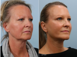 Before and after photos of a deep plane facelift surgery performed by Dr. Edwin Williams