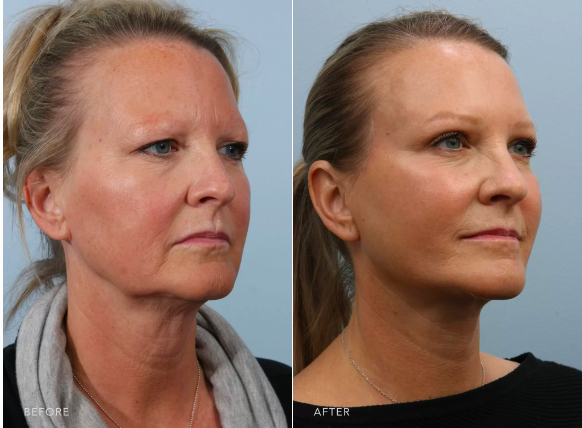 Patient showcasing before and after undergoing a deep plane facelift. 