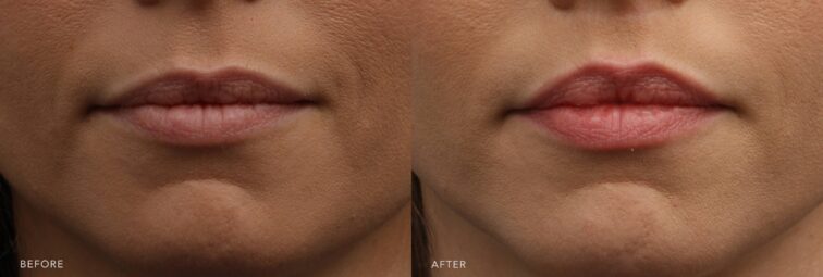 A photo of a woman's lower face before and after the Lip Lift procedure. Before photo shows dull, rough, and lacks the usual smooth lip texture, with the natural sheen of healthy lips replaced with a matte or flaky surface. The after photo shows a smooth surface with a uniform texture across her lips, enhancing their visual appeal. | Albany, Latham, Saratoga NY, Plastic Surgery