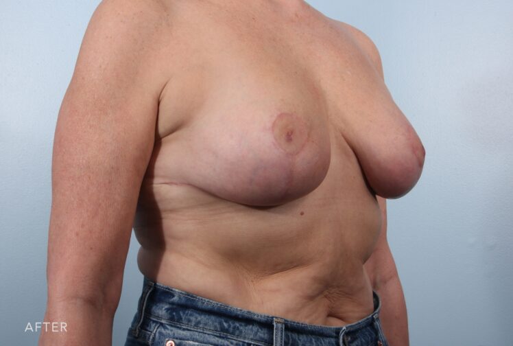 A photo of a woman's body shows her breasts that maintain a harmonious and balanced appearance, contributing to her overall body symmetry. | Albany, Latham, Saratoga NY, Plastic Surgery 