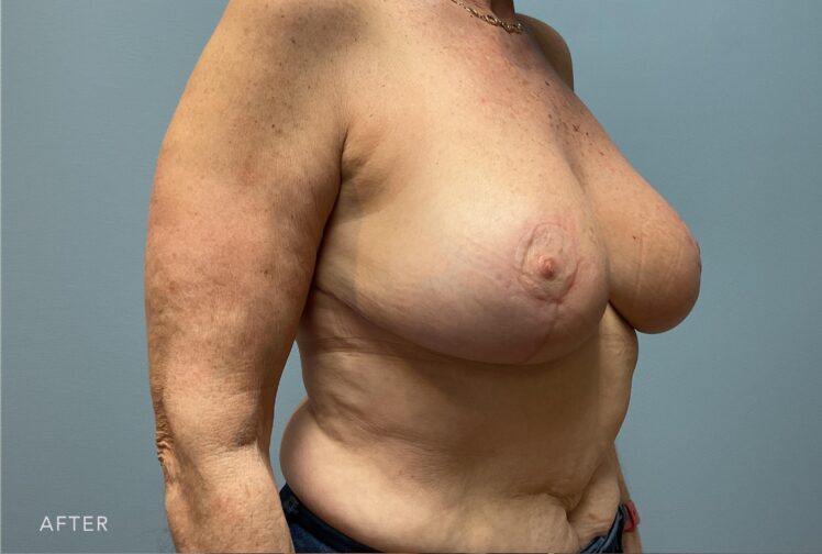 A photo of a woman's body shows a smaller breast size compared to their original size, resulting in a more proportionate appearance. | Albany, Latham, Saratoga NY, Plastic Surgery 