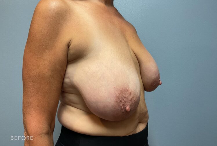 A photo of a woman's body shows a noticeable asymmetry between her breasts, with one breast appearing larger and lower than the other. | Albany, Latham, Saratoga NY, Plastic Surgery 