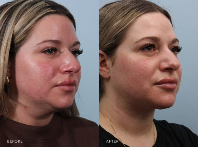 A side-by-side view of a woman's face before and after the Deep Neck Lift procedure. Before photo shows a less defined or obscured jawline and neckline with the presence of excess fat, creating a less sculpted or toned appearance. The after photo shows an enhanced overall contour of her neck, with a reduction of sagging or drooping, contributing to a rejuvenated and refreshed appearance. | Albany, Latham, Saratoga NY, Plastic Surgery