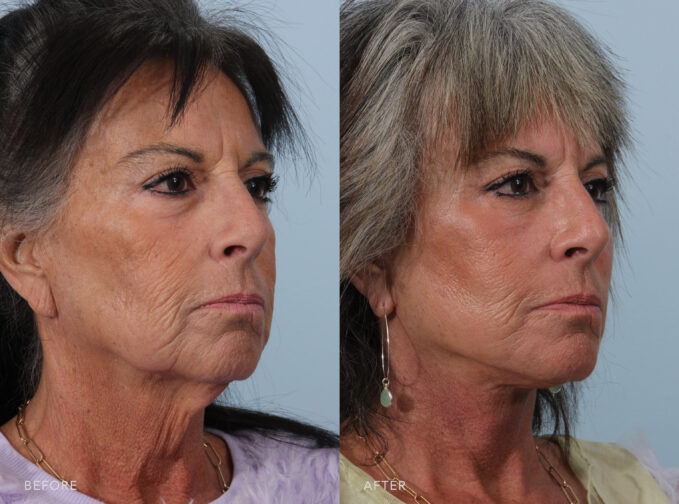 A side-by-side view of a woman's face before and after the Deep Plane Lower Face and Neck Lift procedure. Before photo shows loss of skin elasticity and firmness, resulting in sagging or drooping of her facial contours, including the cheeks, jowls, and neck. The after photo shows firm and well-defined facial contours, including a sculpted jawline, lifted cheeks, and taut skin, adding to a youthful and rejuvenated appearance. | Albany, Latham, Saratoga NY, Plastic Surgery 