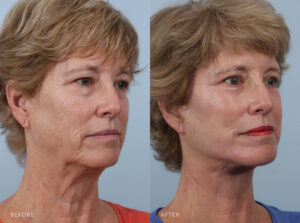 A side-by-side view of a woman's face before and after the Facelift procedure. Before photo shows rough and uneven skin texture, with areas of thinning or laxity contributing to the appearance of wrinkles. The after photo shows even and uniform skin tone across her entire face, with minimal variations or discolorations, contributing to a flawless complexion. | Albany, Latham, Saratoga NY, Plastic Surgery