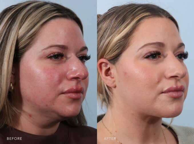 A side-by-side view of a woman's face before and after the Deep Neck Lift procedure. Before photo shows a less defined or obscured jawline and neckline with the presence of excess fat, creating a less sculpted or toned appearance. The after photo shows an enhanced overall contour of her neck, with a reduction of sagging or drooping, contributing to a rejuvenated and refreshed appearance. | Albany, Latham, Saratoga NY, Plastic Surgery