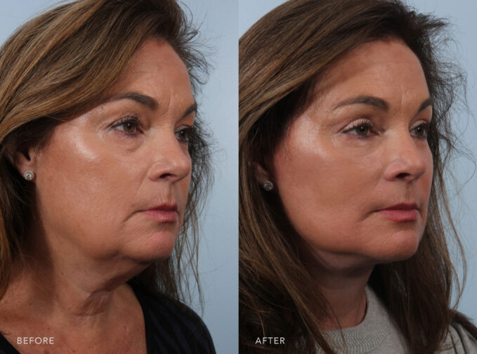 A side-by-side view of a woman's face before and after the Facelift procedure. Before photo shows visible sagging skin in her neck area, accompanied by horizontal neck bands, adding to her tired and aged appearance. The after photo shows high and prominent cheekbones with lifted and plump cheeks, creating a youthful and energetic appearance. | Albany, Latham, Saratoga NY, Plastic Surgery