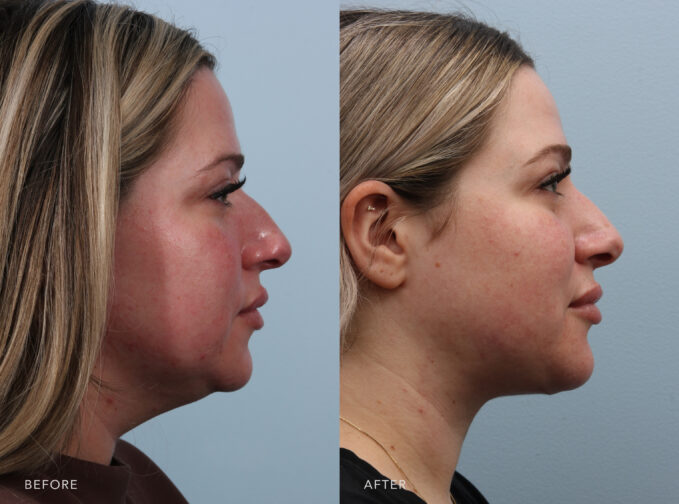 A side-by-side view of a woman's face before and after the Rhinoplasty procedure. Before photo shows a visibly crooked or tilted nose to one side when viewed from the front or in profile. The after photo shows a straighter and smoother nasal bridge, contributing to a more aesthetically pleasing facial profile. | Albany, Latham, Saratoga NY, Plastic Surgery