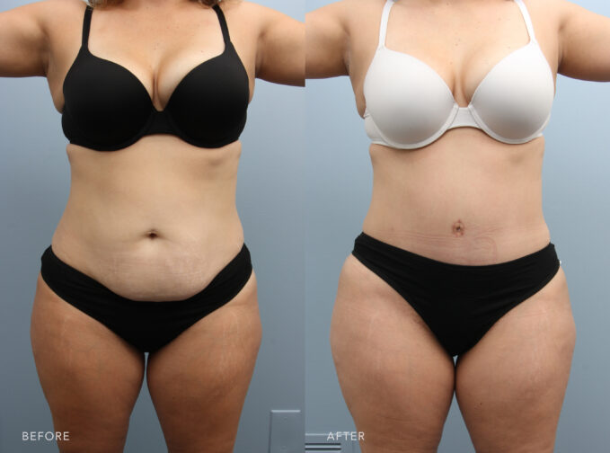 A photo of a woman's body before and after the Abdominoplasty with Liposuction procedure. Before photo shows an abdomen that appears round and protruding due to the accumulation of excess fat, giving a chubby look. The after photo shows a flat and well-toned abdomen, with a sleek appearance and good muscle definition. | Albany, Latham, Saratoga NY, Plastic Surgery