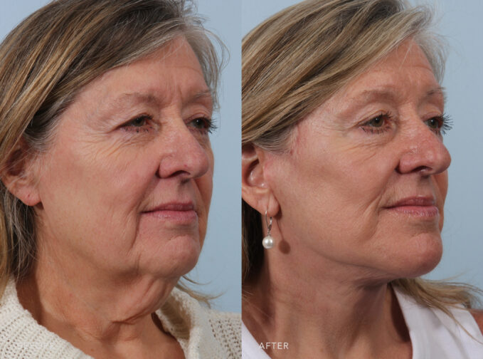 A side-by-side view of a woman's face before and after the Deep Plane Lower Face and Neck Lift procedure. Before photo shows lines or creases extending from the corners of her mouth towards the chin, contributing to a sad or downturned expression. The after photo shows a noticeable firmness to her skin, especially around her cheeks, jawline, and forehead, giving a well-toned look without appearing overly taut. | Albany, Latham, Saratoga NY, Plastic Surgery 