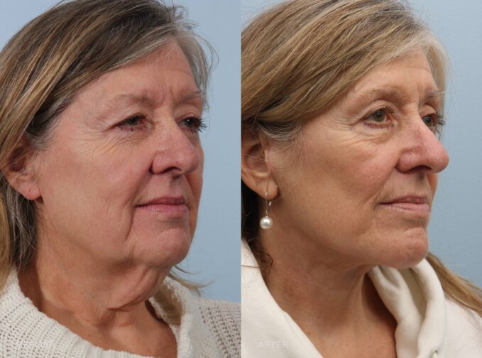 A side-by-side view of a woman's face before and after the Deep Plane Lower Face and Neck Lift procedure. Before photo shows visible neck bands or loose skin indicates aging and the loss of skin elasticity. The after photo shows subtle tightness and is natural, avoiding an over-stretched or artificial appearance and maintaining her natural beauty and expression. | Albany, Latham, Saratoga NY, Plastic Surgery 