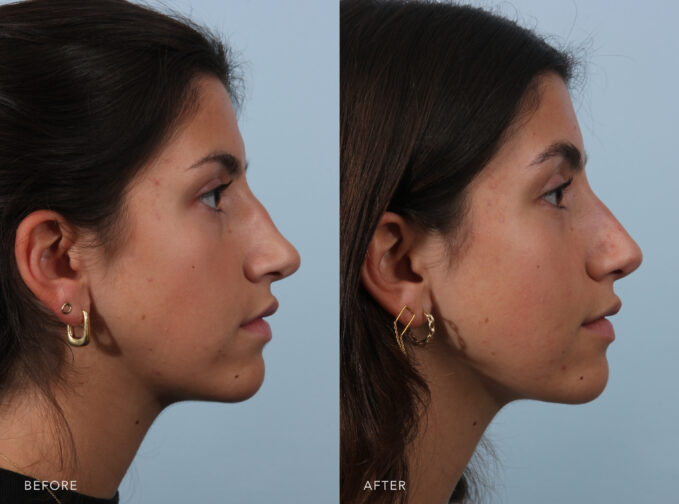 A side-by-side view of a woman's face before and after the Rhinoplasty procedure. Before photo shows a humpy nose, creating a visual disconnection between her nasal tip and the bridge and making the tip appear droopy or less defined. The after photo shows a symmetrical nose with both sides mirroring each other in terms of shape and size, enhancing the overall balance of her facial features. | Albany, Latham, Saratoga NY, Plastic Surgery 