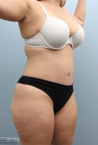 A photo of a woman's body shows a firm and tight abdomen, without any signs of sagging or looseness, indicating good skin elasticity. | Albany, Latham, Saratoga NY, Plastic Surgery