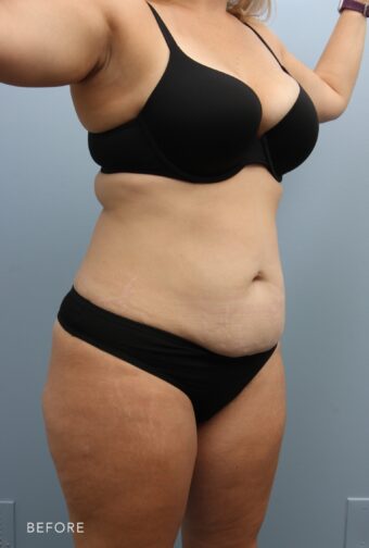 A photo of a woman's body shows an abdomen with loose skin and lacks firmness, hanging or drooping in certain areas, indicating a loss of skin elasticity. | Albany, Latham, Saratoga NY, Plastic Surgery